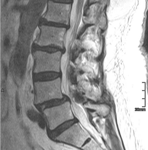 abb2 Spinalstenose 2 Wirbelsäulenchirurgie