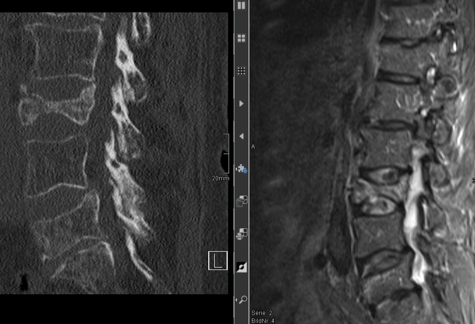 wscabb11 Wirbelsäulenverletzungen 1 Wirbelsäulenchirurgie
