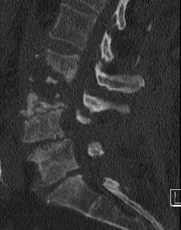 wscabb2 Wirbelsäuleninfektionen 2 Wirbelsäulenchirurgie