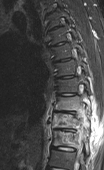 wscabb3 Wirbelsäuleninfektionen 3 Wirbelsäulenchirurgie
