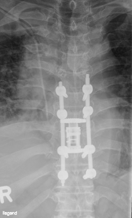 wscabb5 Wirbelsäuleninfektionen 5 Wirbelsäulenchirurgie