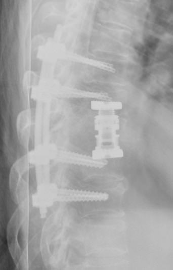 wscabb6 Wirbelsäuleninfektionen 6 Wirbelsäulenchirurgie